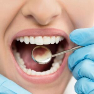 Composite Fillings