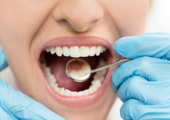 Composite Fillings